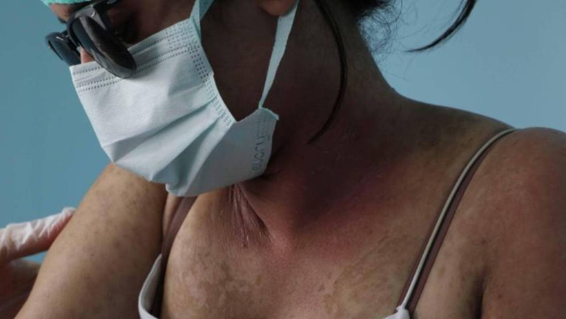 İnternetten Aldığı Kremde Kezzap Etkili Madde Çıktı! Bütün Hayatı Karardı - Resim : 1