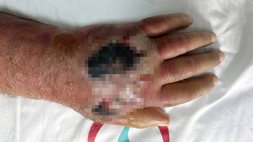 Hırsızın Isırdığı Eli Amputasyondan Döndü! Nadir Görülen Vaka Literatüre Giriyor - Resim : 1