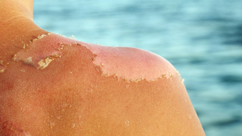 250 Liralık Kabus! Güneş Kreminin Alternatifinde Gizli Tehlike, Vakalar Artabilir - Resim : 2