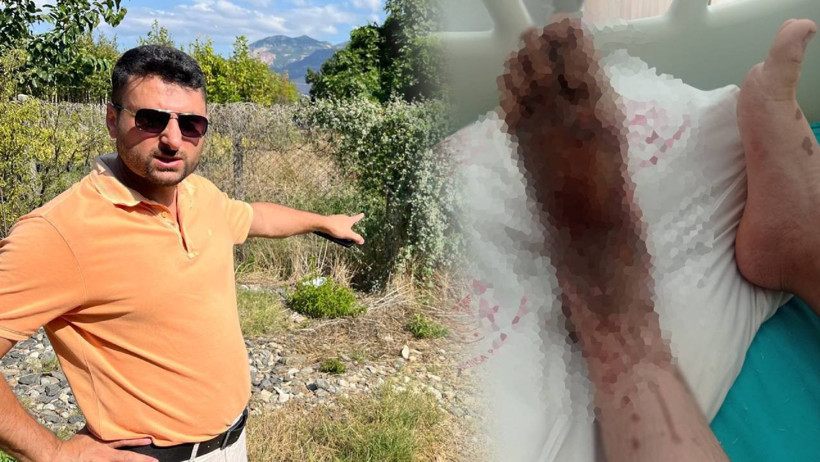 14 yaşındaki çocuğun ayağında yanıklar oluştu.