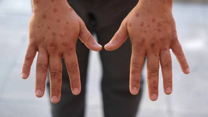 O Salgın Tekrardan Hortladı! Hızla Vakalar Artıyor, O Ülke Karantina Altına Alınabilir - Resim : 2