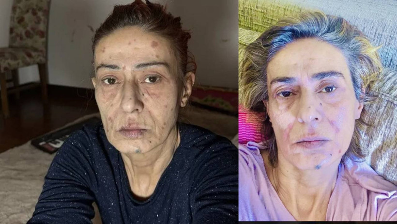 Yıldız Tilbe’nin Son Hali Sevenlerini Üzdü! Yüzündeki İzler Korkuttu - Resim : 1