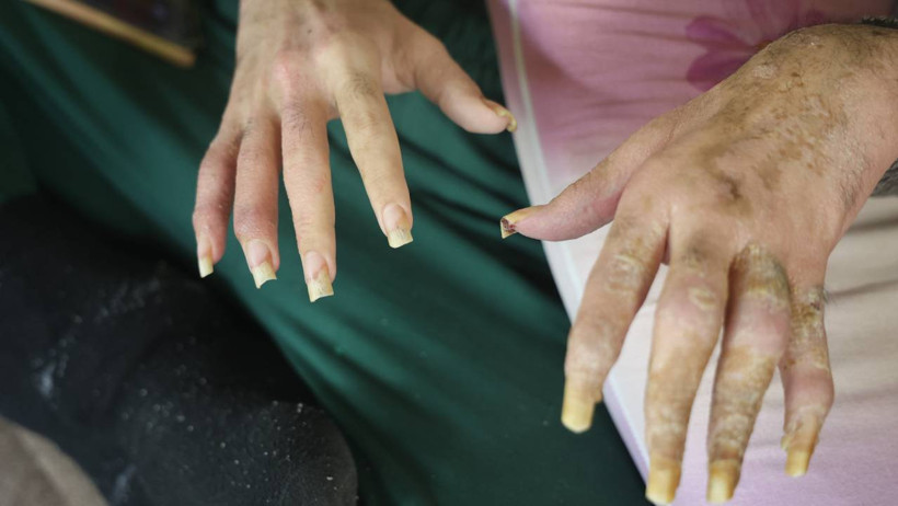 Hayatla Bağını Kopardı... Banyo Yapmıyor, Tırnaklarını Kesmiyor: 'Hayalim Yok, Evde Oturacağım' - Resim : 1