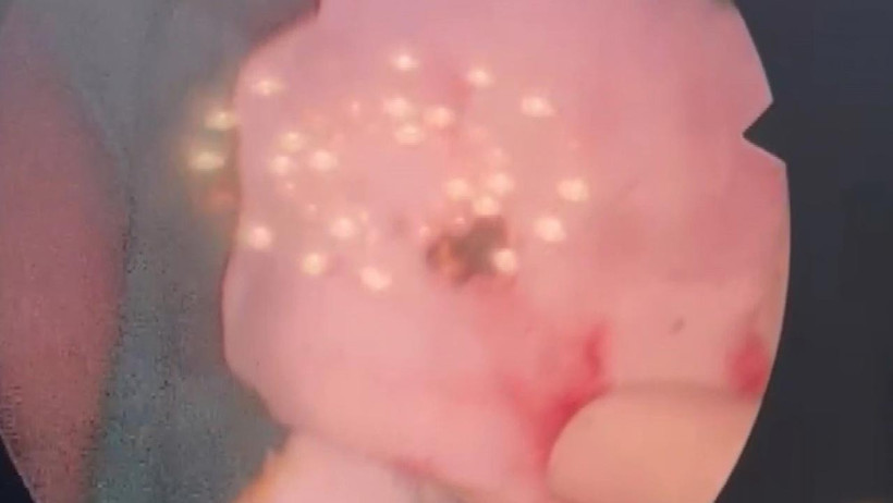 Estetik Ameliyatta Şok Olay: Burundan Taş Çıktı - Resim : 3