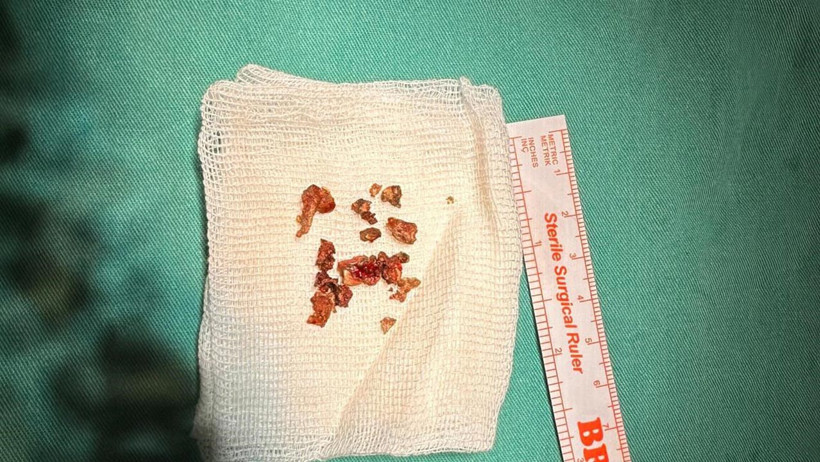 Estetik Ameliyatta Şok Olay: Burundan Taş Çıktı - Resim : 1