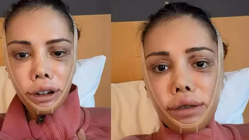 Y&uuml;z Nakli Yaptırmıştı, Didem Ceran Hastalığını Ağlayarak A&ccedil;ıkladı - Resim : 1