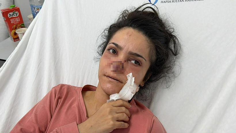 Eşi Tarafından Burnu Isırılıp Koparılan İmran Dehşeti Anlattı: 'Acıyla Balkondan Atlamayı Düşündüm' - Resim : 2