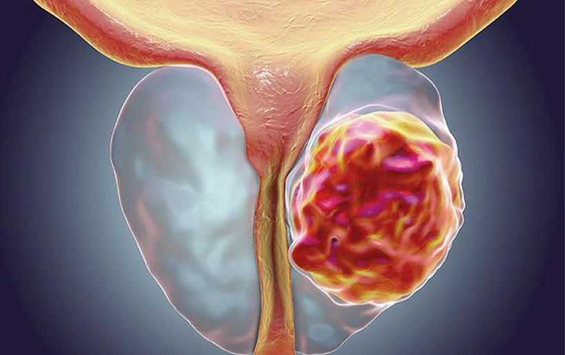 Her 7 Erkekten 1'inde Var! İşte En Sık Görülen İkinci Kanser Türü - Resim : 1