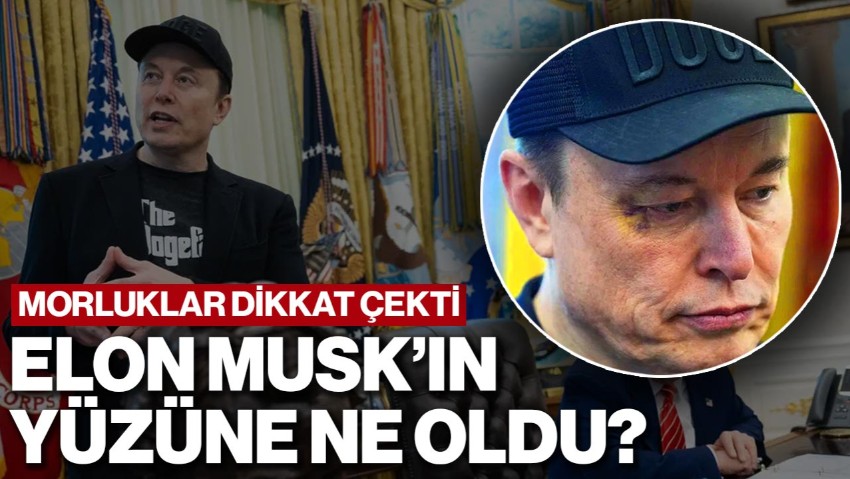 Morluklar Dikkat Çekti... Elon Musk’ın Yüzüne Ne Oldu? İlk Kez Açıkladı